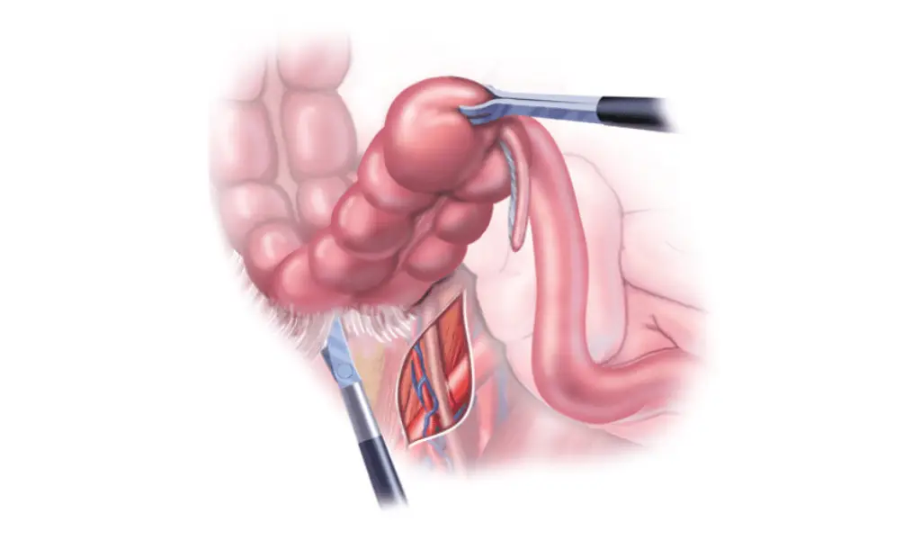 Comprehensive Guide to Outpatient Colon Surgery